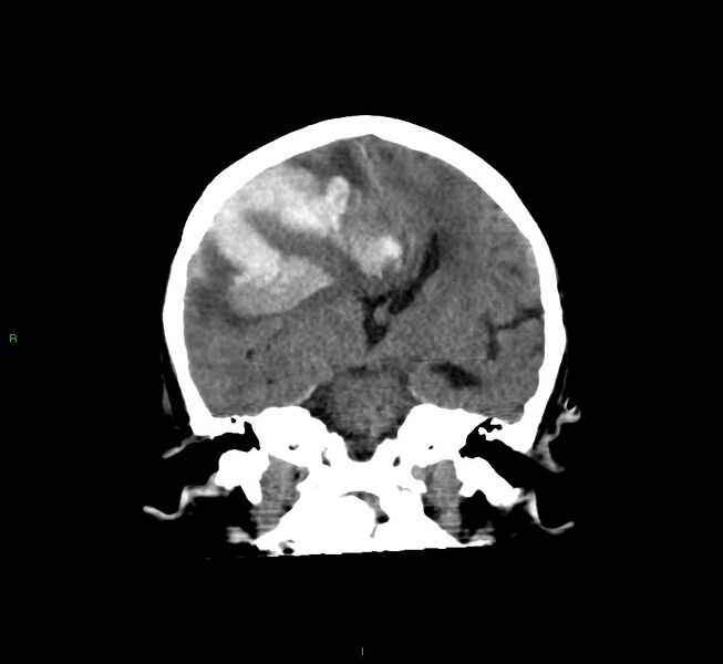 File:Cerebral amyloid angiopathy-associated lobar intracerebral hemorrhage (Radiopaedia 58560-65723 Coronal non-contrast 38).jpg