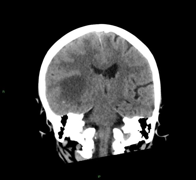 File:Cerebral amyloid angiopathy-associated lobar intracerebral hemorrhage (Radiopaedia 58563-65727 Coronal non-contrast 33).jpg