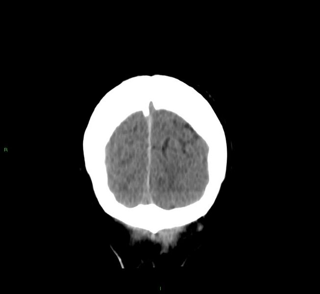 File:Cerebral amyloid angiopathy-associated lobar intracerebral hemorrhage (Radiopaedia 58756-65977 Coronal non-contrast 10).jpg