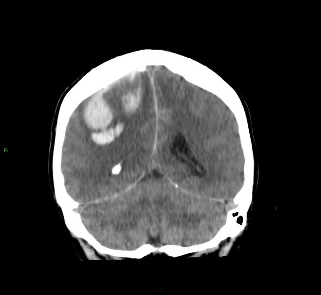 File:Cerebral amyloid angiopathy-associated lobar intracerebral hemorrhage (Radiopaedia 58756-65977 Coronal non-contrast 24).jpg