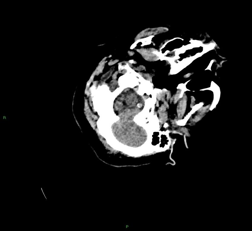 Cerebral amyloid angiopathy-associated lobar intracerebral hemorrhage (Radiopaedia 58757-65979 Axial non-contrast 18).jpg