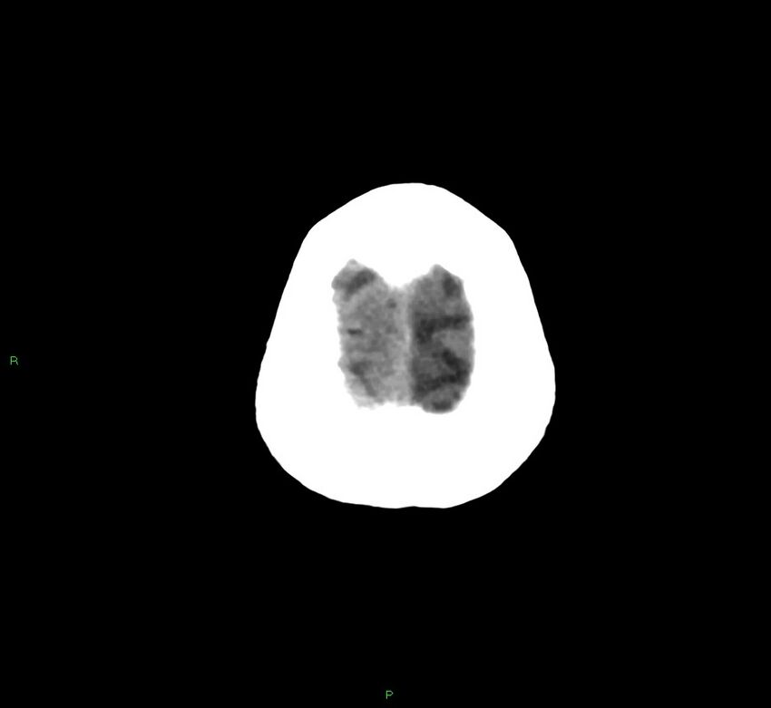 Cerebral amyloid angiopathy-associated lobar intracerebral hemorrhage (Radiopaedia 58758-65980 Axial non-contrast 5).jpg