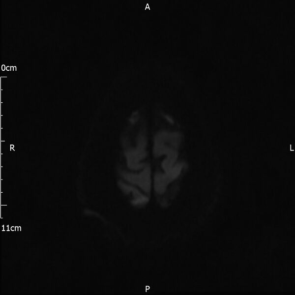 File:Cerebral amyloid angiopathy related inflammation (Radiopaedia 72772-83415 Axial DWI 68).jpg