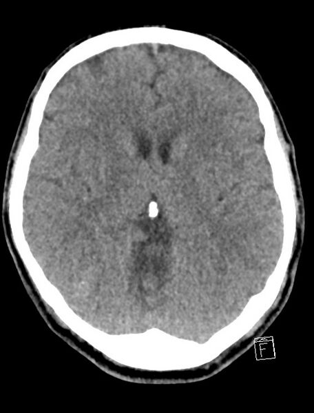 File:Cerebral arteriovenous malformation (Radiopaedia 78188-90745 Axial non-contrast 12).jpg