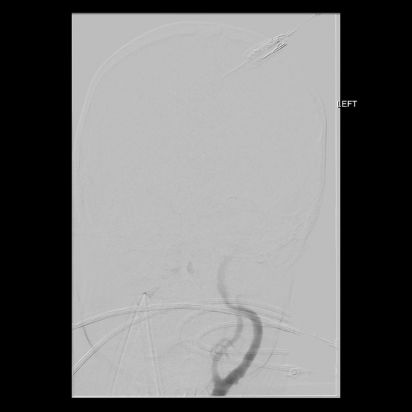 File:Cerebral arteriovenous malformation with lobar hemorrhage (Radiopaedia 44725-48513 LT CCA IC 7).png