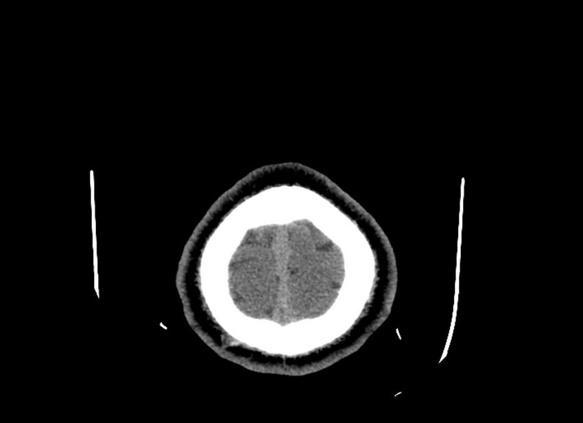 Cerebral edema (Radiopaedia 82519-96661 Axial non-contrast 5).jpg