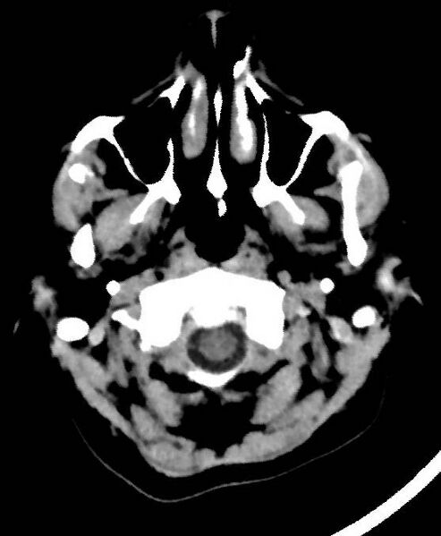 File:Cerebral edema due to severe hyponatremia (Radiopaedia 89826-106937 Axial non-contrast 3).jpg
