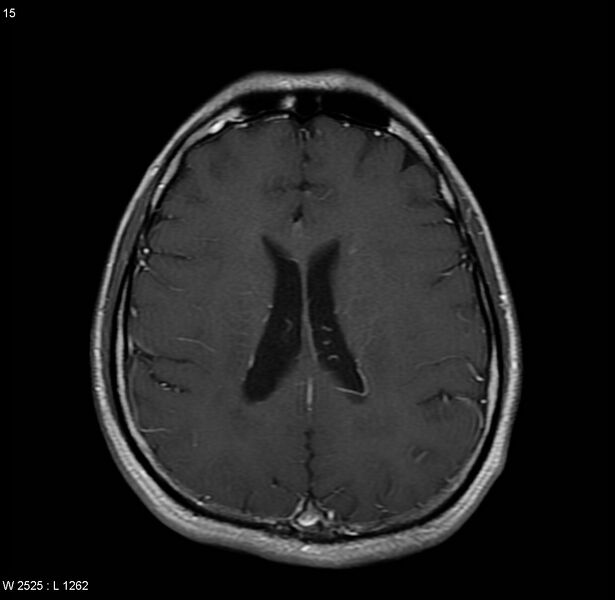 File:Cerebral vasculitis (Radiopaedia 5131-6923 Axial T1 C+ 4).jpg