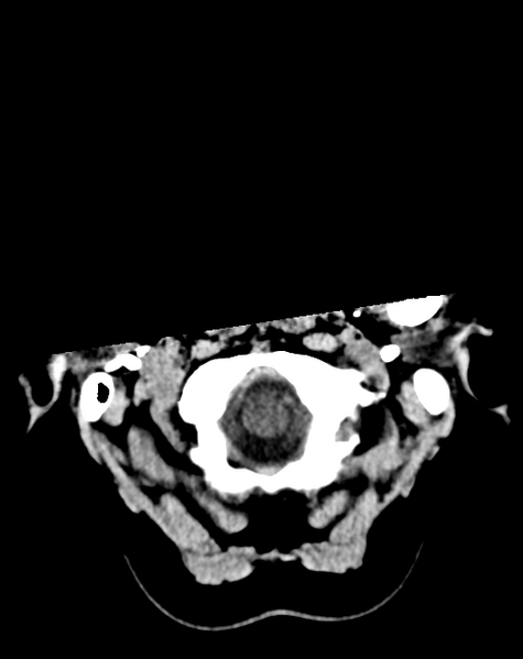 File:Cerebral venous infarct related to dural venous sinus thromboses (Radiopaedia 35292-36803 AXIAL THICK 2).png