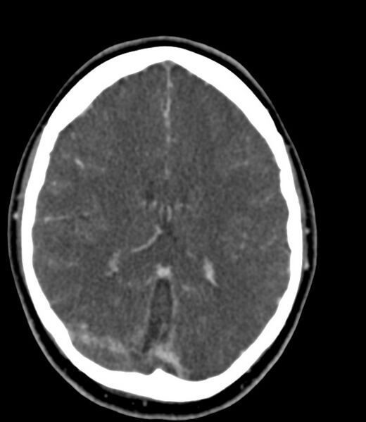 File:Cerebral venous sinus thrombosis (Radiopaedia 59224-66646 Axial C+ delayed 24).jpg