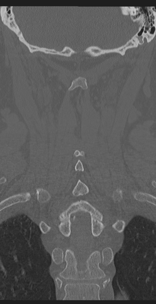 File:Cervical canal stenosis - OPLL and osteophytes (Radiopaedia 47329-51910 Coronal bone window 46).png
