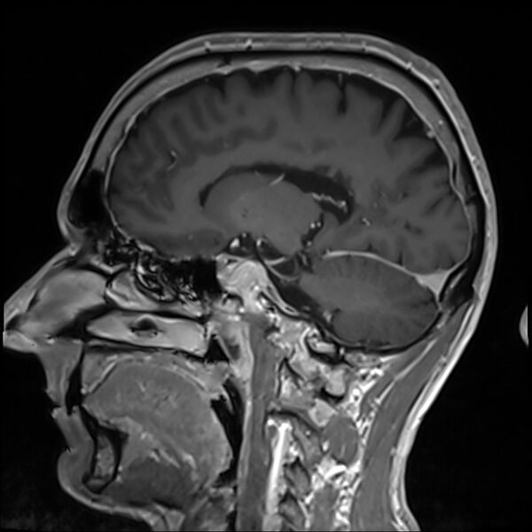 File:Cervical dural CSF leak on MRI and CT treated by blood patch (Radiopaedia 49748-54995 G 43).jpg