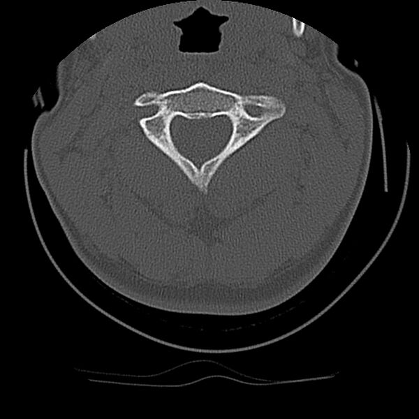 File:Cervical flexion teardrop fracture with cord hemorrhage (Radiopaedia 32497-33454 Axial bone window 25).jpg