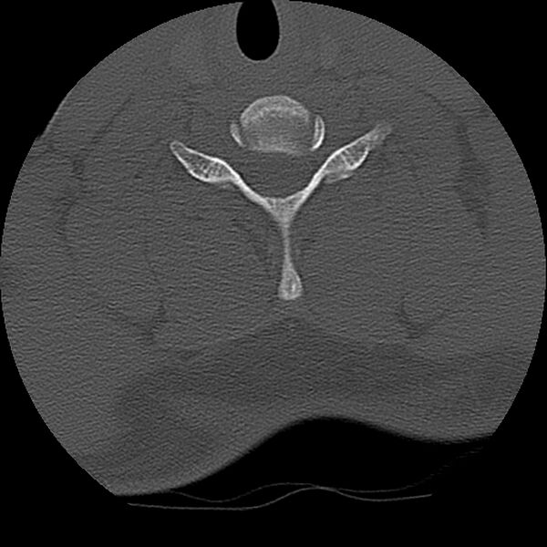File:Cervical flexion teardrop fracture with cord hemorrhage (Radiopaedia 32497-33454 Axial bone window 63).jpg