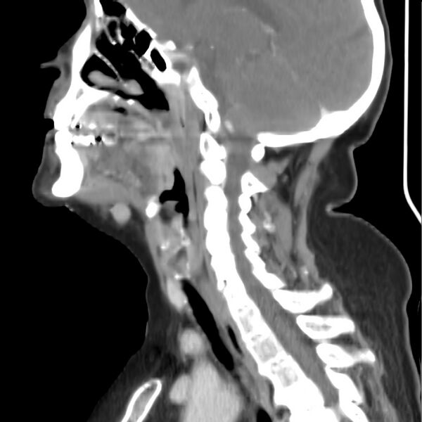 File:Cervical lymphadenopathy- cause unknown (Radiopaedia 22420-22457 D 22).jpg