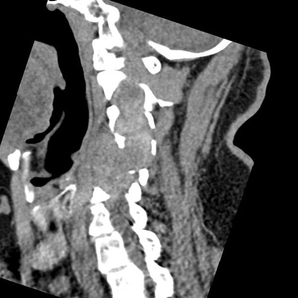 File:Cervical spinal neurofibroma in a patient with NF1 (Radiopaedia 58344-65464 C 21).jpg