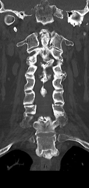 File:Cervical spine fracture - chalk stick (Radiopaedia 39116-41323 Coronal bone window 23).png
