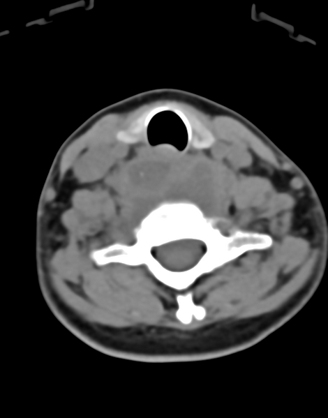 File:Cervical tuberculous spondylitis (Radiopaedia 39149-41365 Axial non-contrast 38).png