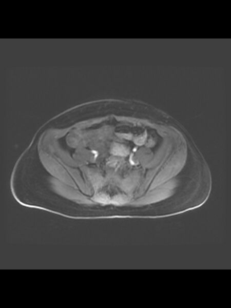 File:Cesarean section scar endometrioma (Radiopaedia 56569-63297 Axial T1 C+ fat sat 36).jpg