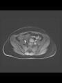 Cesarean section scar endometrioma (Radiopaedia 56569-63297 Axial T1 C+ fat sat 36).jpg