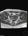 Cesarian scar endometriosis (Radiopaedia 68495-78066 Axial T1 13).jpg