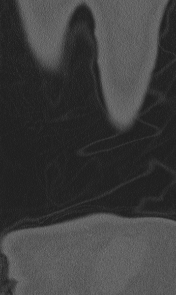 File:Chance fracture (Radiopaedia 40360-42912 Coronal bone window 76).png