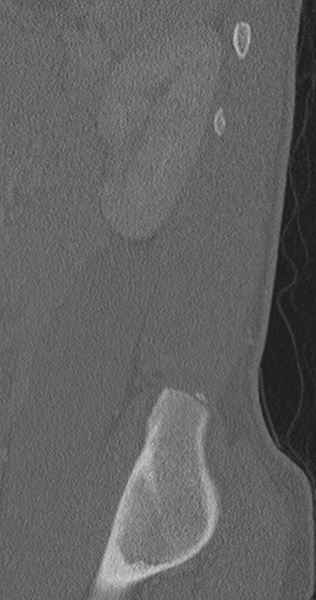 File:Chance fracture (Radiopaedia 40360-42912 Sagittal bone window 14).png