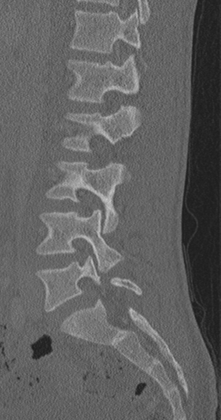 File:Chance fracture (Radiopaedia 40360-42912 Sagittal bone window 60).png