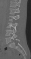 Chance fracture (Radiopaedia 40360-42912 Sagittal bone window 60).png
