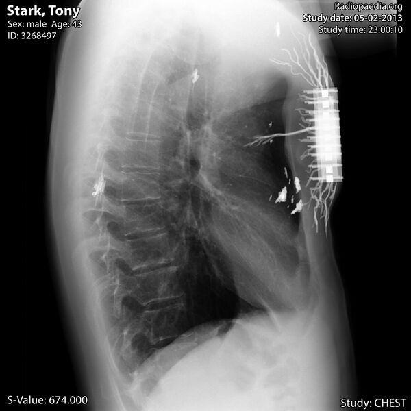 File:Chest x-ray of Tony Stark (Iron man) (Radiopaedia 24511-24799 B 1).jpg