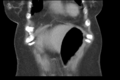 Cholecystitis - CT IVC obstructive choledocholitiasis (Radiopaedia 43966-47479 Coronal Biliscopin 10).png