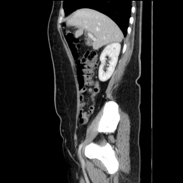 File:Choledocholithiasis on CT and MRI (Radiopaedia 24825-25087 D 21).jpg