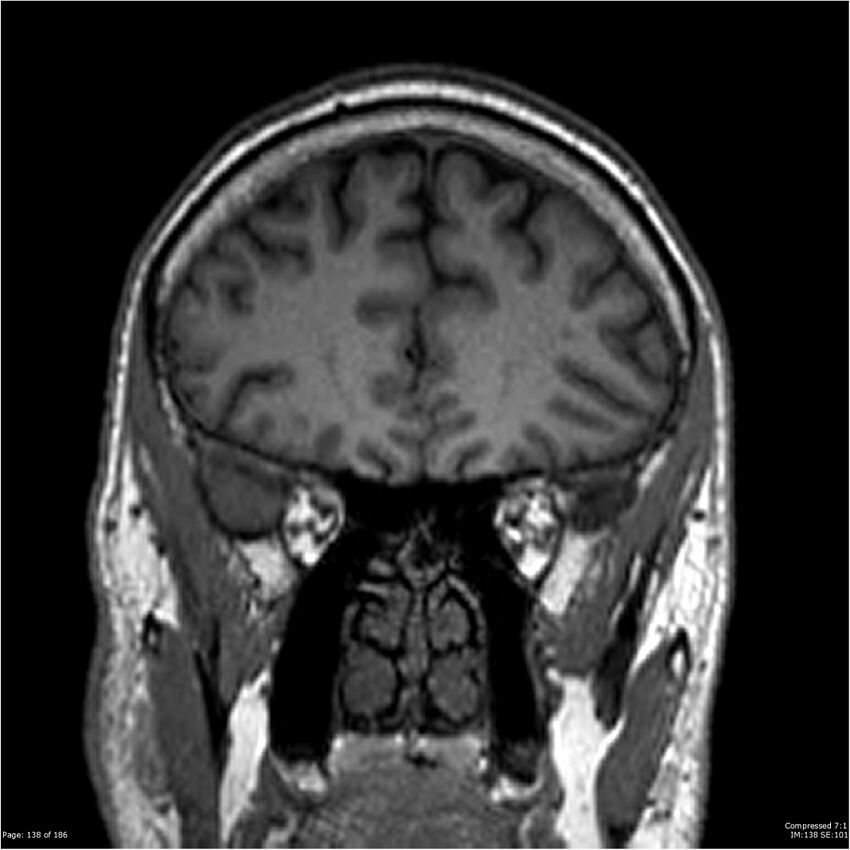 Chondrosarcoma of skull base- grade II (Radiopaedia 40948-43654 Coronal T1 59).jpg