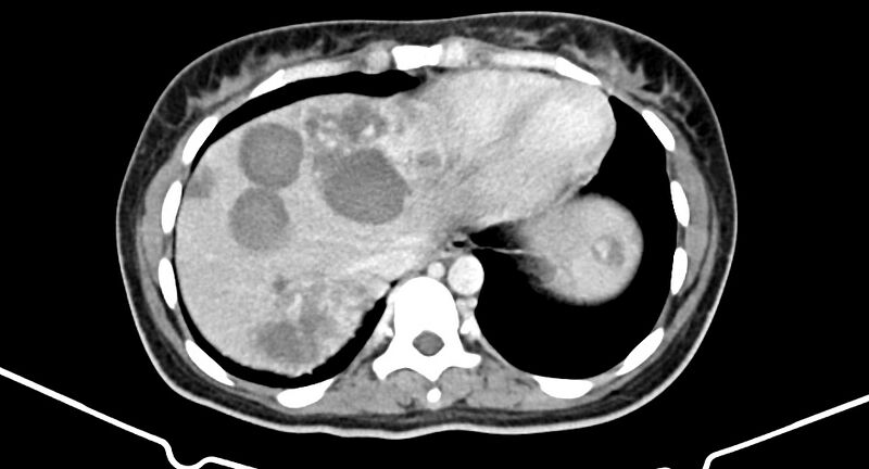 File:Choriocarcinoma liver metastases (Radiopaedia 74768-85766 A 28).jpg