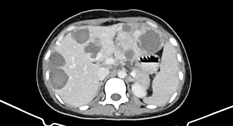 File:Choriocarcinoma liver metastases (Radiopaedia 74768-85766 A 69).jpg