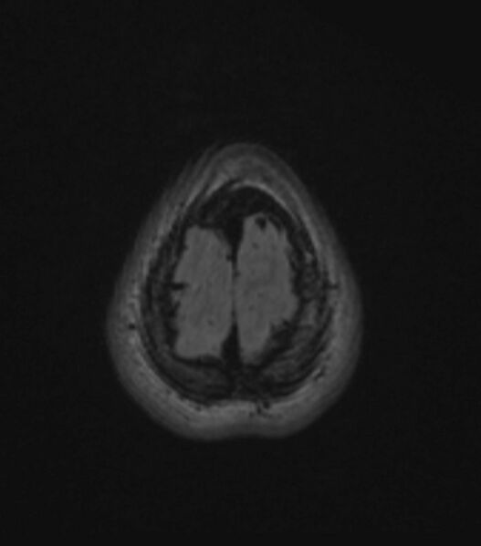 File:Choroid plexus carcinoma (Radiopaedia 91013-108553 Axial FLAIR C+ 196).jpg