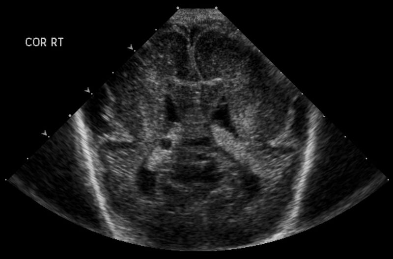 File:Choroid plexus cyst - antenatal (Radiopaedia 5680).jpg