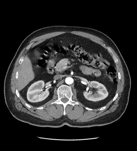 File:Chromophobe renal cell carcinoma (Radiopaedia 86879-103083 B 52).jpg
