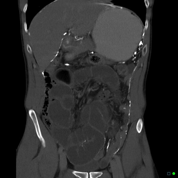 File:Chronic barium peritonitis and small bowel obstruction (Radiopaedia 29151-29548 C 1).jpg