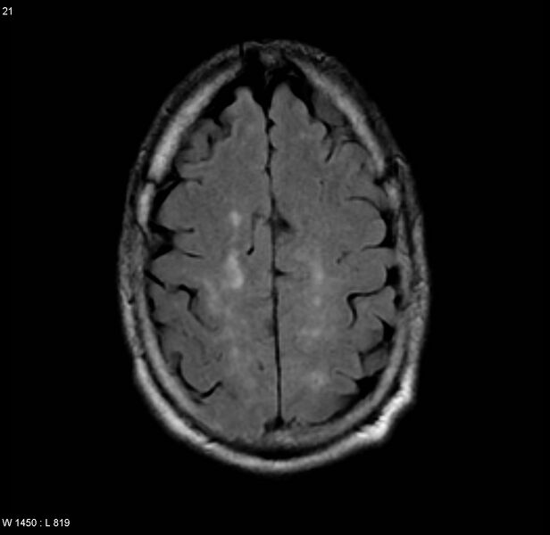 File:Chronic hypertensive encephalopathy (Radiopaedia 4564-6686 Axial FLAIR 14).jpg