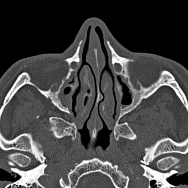 File:Chronic maxillary sinusitis (Radiopaedia 27879-28116 Axial bone window 22).jpg