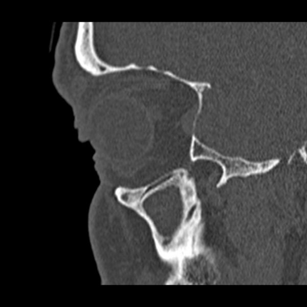 File:Chronic maxillary sinusitis (Radiopaedia 27879-28116 Sagittal bone window 7).jpg