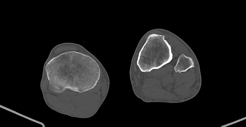File:Chronic osteomyelitis (with sequestrum) (Radiopaedia 74813-85822 Axial non-contrast 202).jpg