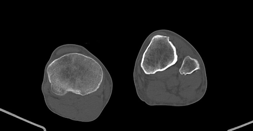 Chronic osteomyelitis (with sequestrum) (Radiopaedia 74813-85822 Axial non-contrast 202).jpg