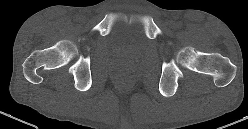 File:Chronic osteomyelitis (with sequestrum) (Radiopaedia 74813-85822 Axial non-contrast 43).jpg