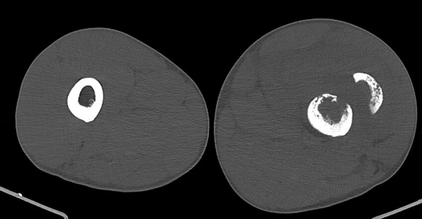Chronic osteomyelitis (with sequestrum) (Radiopaedia 74813-85822 Axial non-contrast 88).jpg