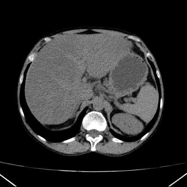 File:Chronic pancreatitis (Radiopaedia 23132-23172 Axial non-contrast 19).jpg