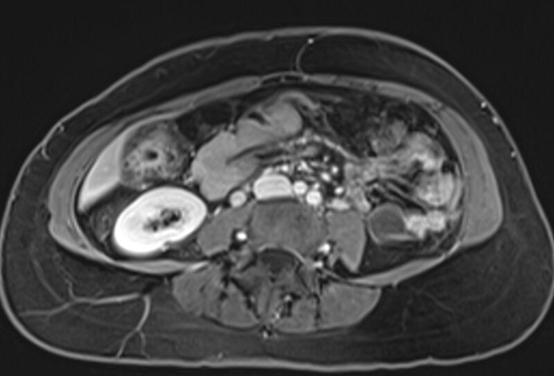 File:Chronic pancreatitis - pancreatic duct calculi (Radiopaedia 71818-82250 Axial T1 C+ fat sat 49).jpg