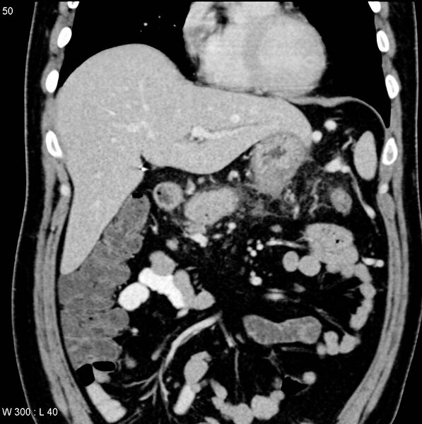 File:Chronic pancreatitis and pseudocysts (Radiopaedia 6724-7935 E 3).jpg