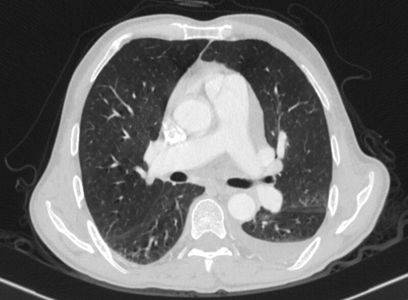 File:Chronic pulmonary embolism with bubbly consolidation (Radiopaedia 91248-108850 Axial lung window 78).jpg